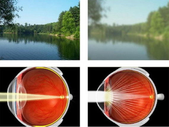 백내장 실명, 백내장 후유증, 백내장 통증, 백내장 재발, 백내장 완치