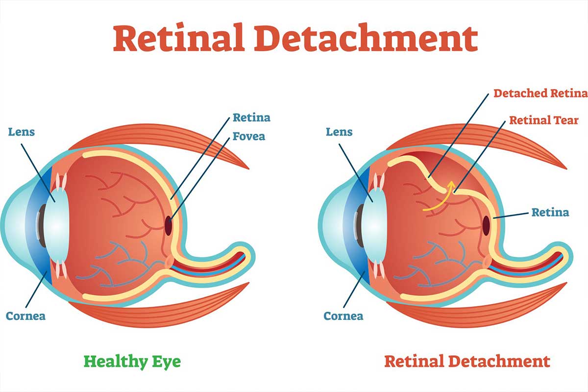 망막열공 증상, 망막열공 레이저, 망막열공 원인, 망막열공 치료, 망막열공 보험
